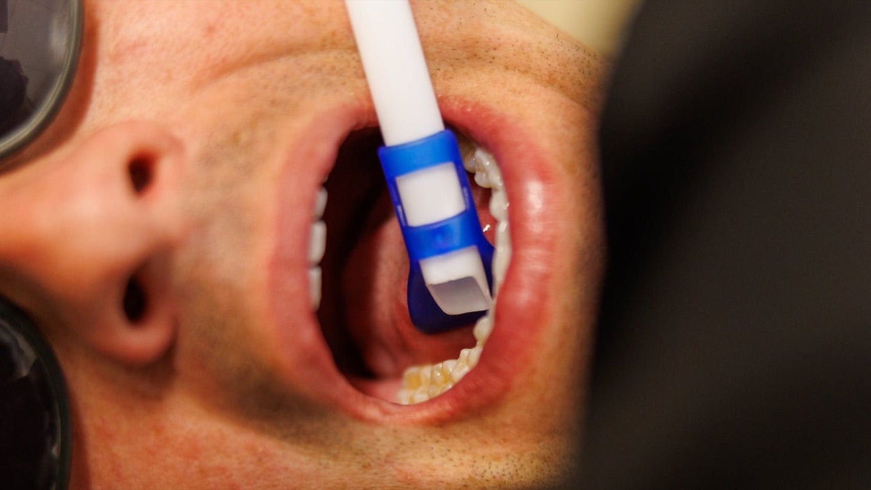 LinguaGuard holding the tongue clear during a dental procedure